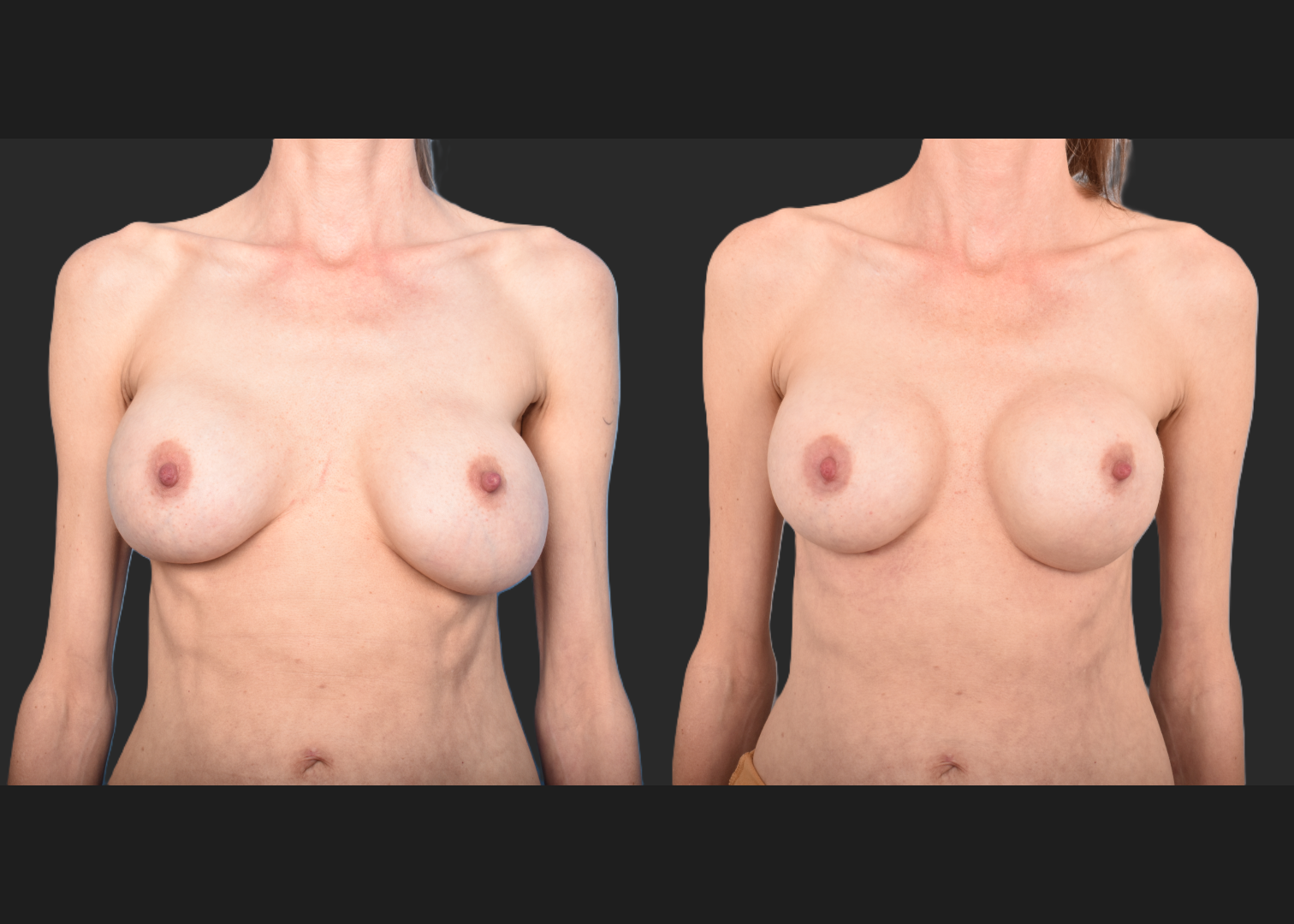 2143129 implant revision saline to silicone exchange natrelle soft touch full profile SSF 325 cc gummy bear pocket correction with internal bra galaflex before after- front