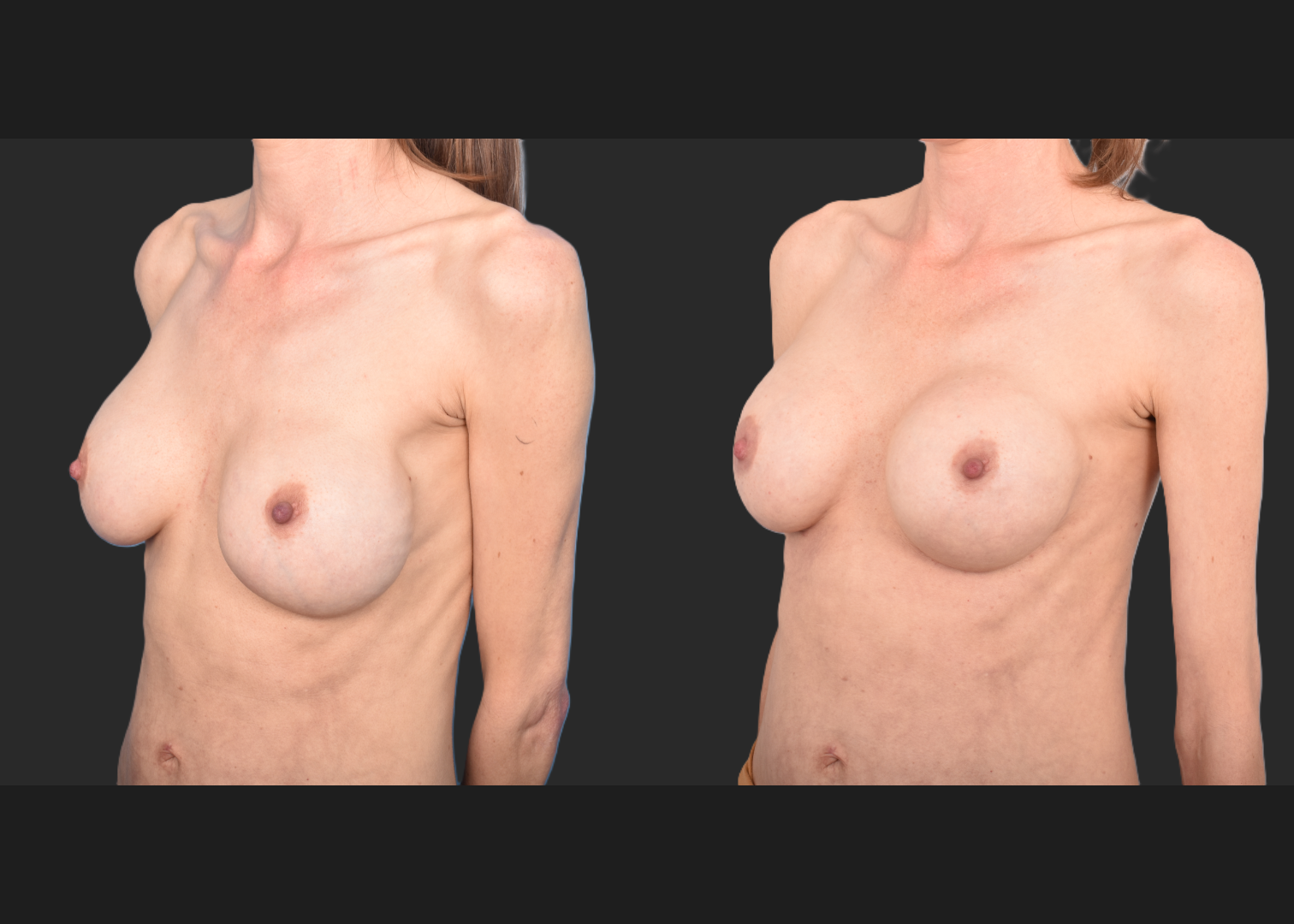 2143129 implant revision saline to silicone exchange natrelle soft touch full profile SSF 325 cc gummy bear pocket correction with internal bra galaflex before after- left oblique