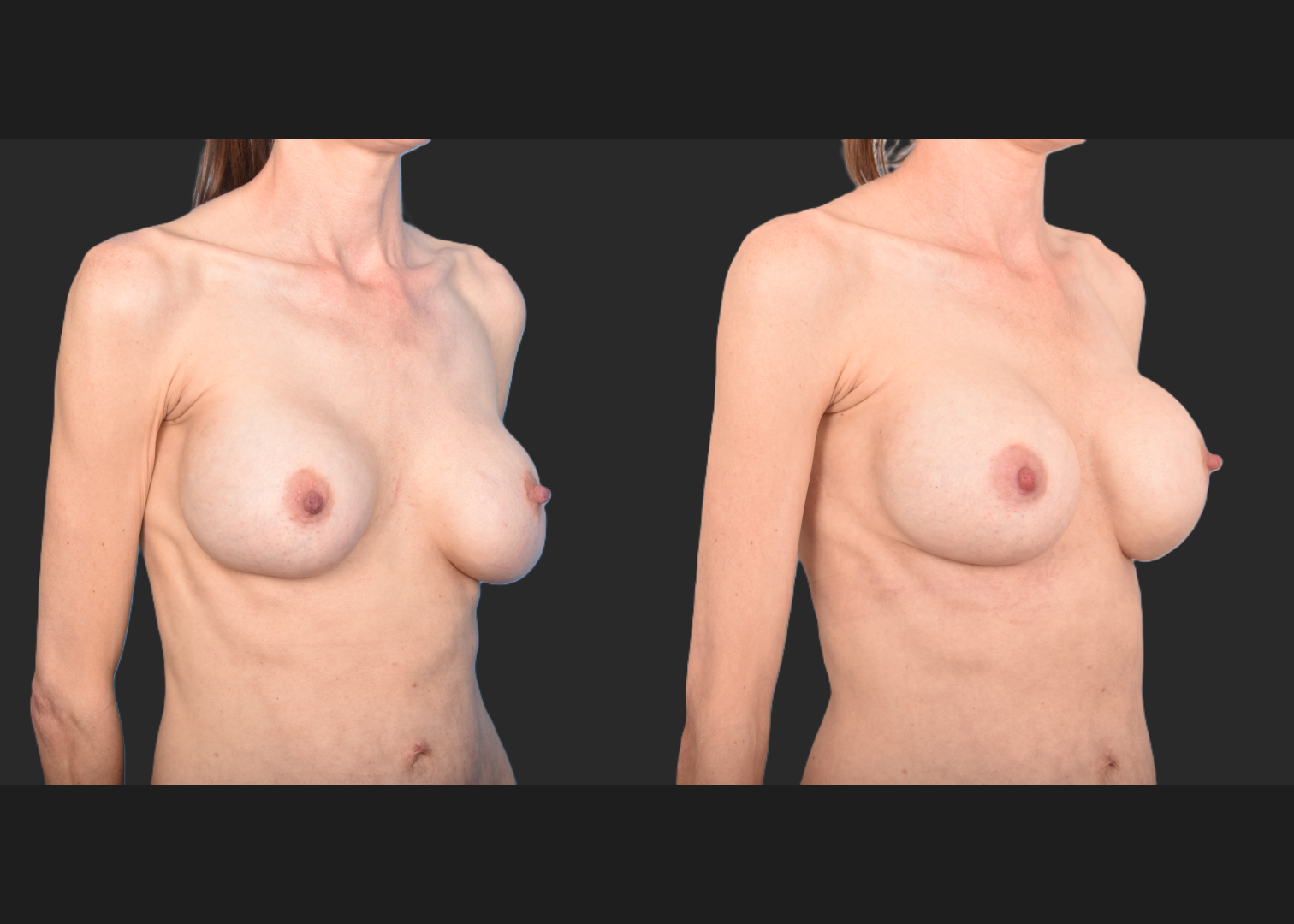 2143129 implant revision saline to silicone exchange natrelle soft touch full profile SSF 325 cc gummy bear pocket correction with internal bra galaflex before after- right oblique