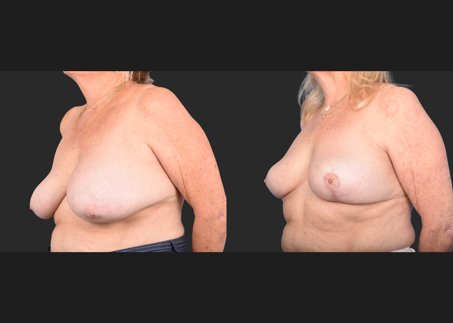 2148563 Saline breast implant removal mastopexy auto-augmentation lift with fat transfer to the breasts before after- left oblique