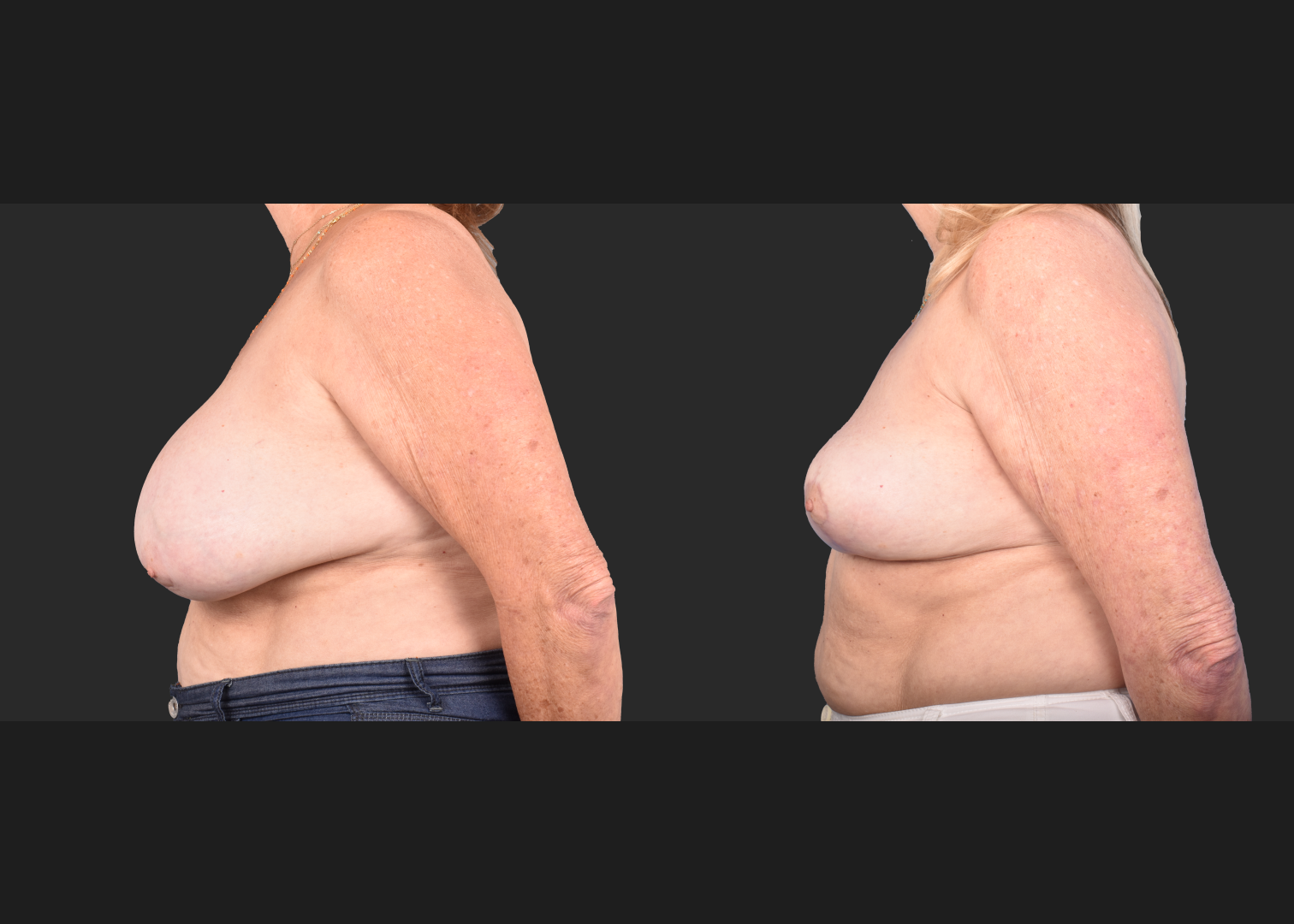 2148563 Saline breast implant removal mastopexy auto-augmentation lift with fat transfer to the breasts before after- left