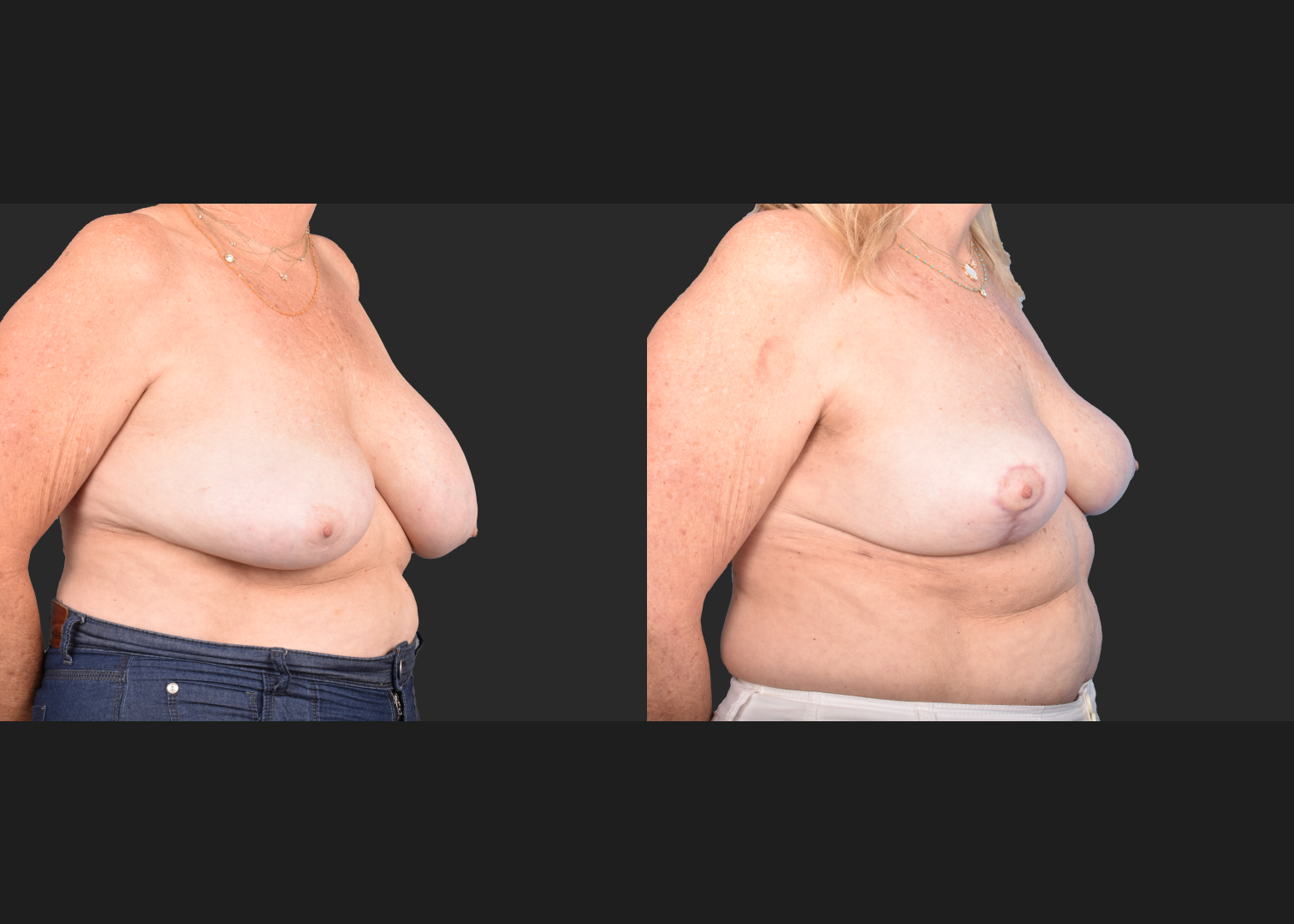 2148563 Saline breast implant removal mastopexy auto-augmentation lift with fat transfer to the breasts before after- right oblique