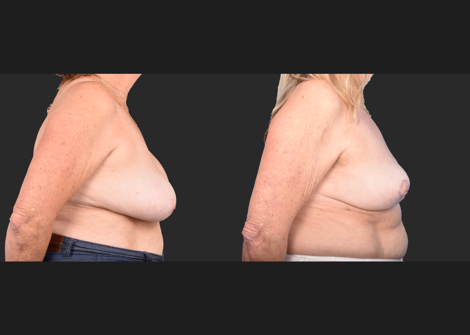 2148563 Saline breast implant removal mastopexy auto-augmentation lift with fat transfer to the breasts before after- right