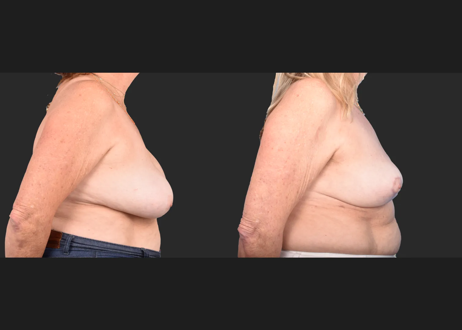 2148563 Saline breast implant removal mastopexy auto-augmentation lift with fat transfer to the breasts before after- right