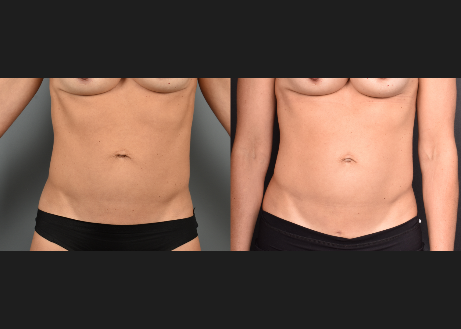 2153367 Abdomen Renuvion Microneedling RF Before After- Front