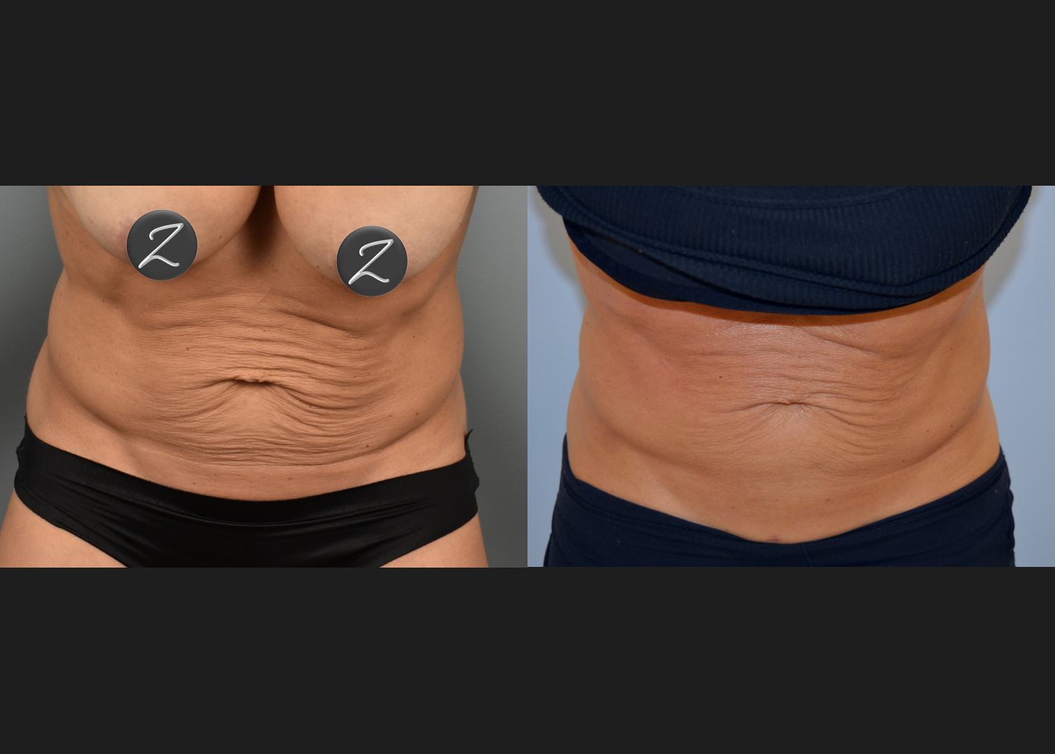 2153367 Abdomen Renuvion Microneedling RF Before After- bent