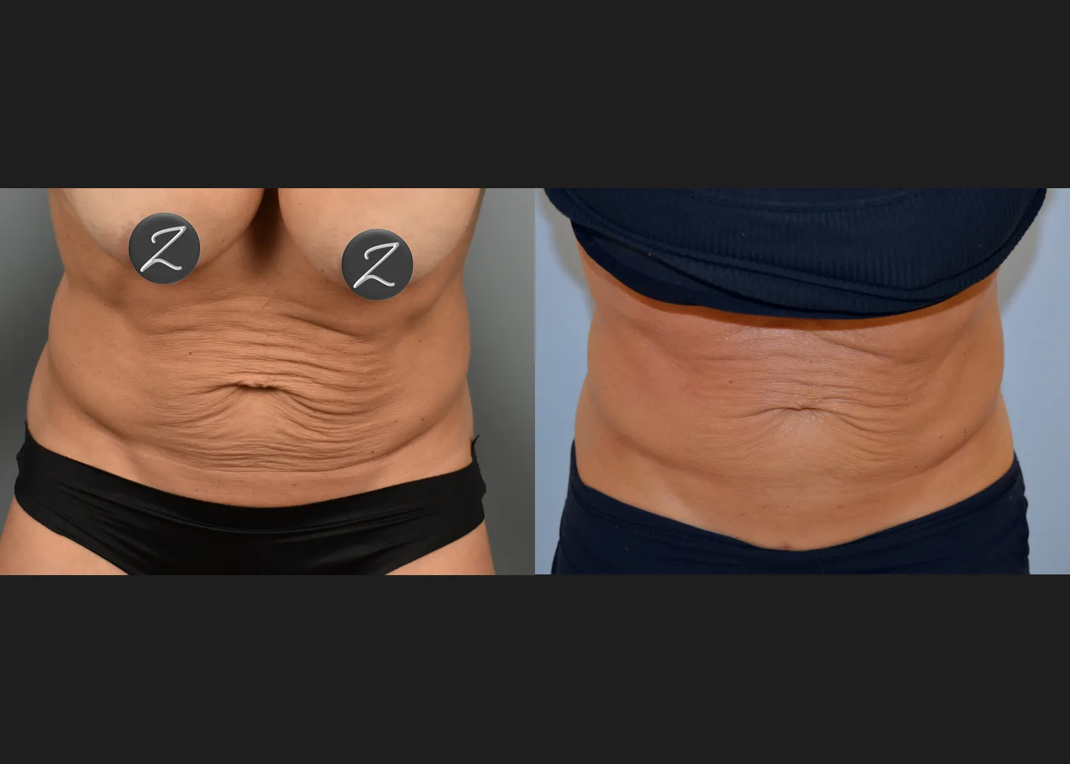 2153367 Abdomen Renuvion Microneedling RF Before After- bent