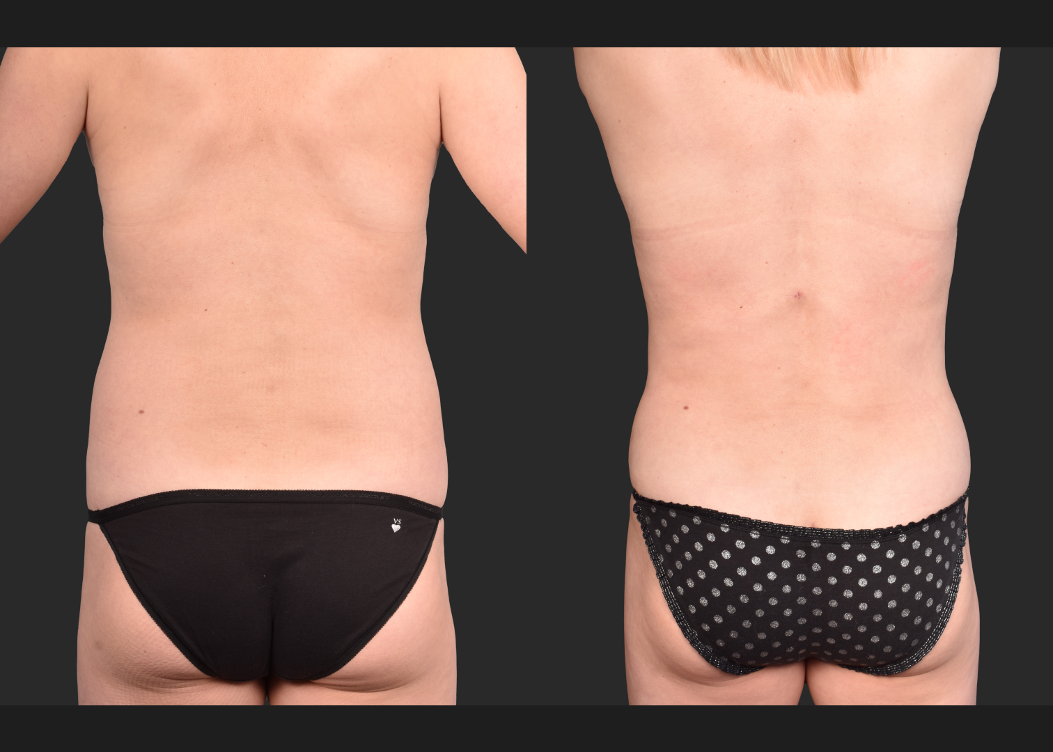 2153897 VASER lipo abdomen lower back 360 contouring renuvion before after- back