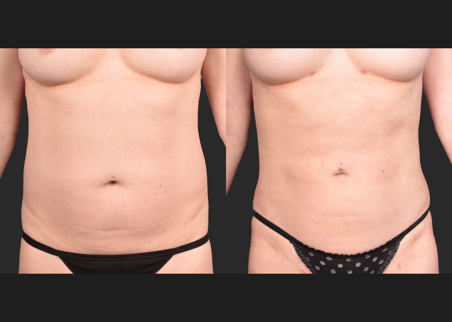 2153897 VASER lipo abdomen lower back 360 contouring renuvion before after- front