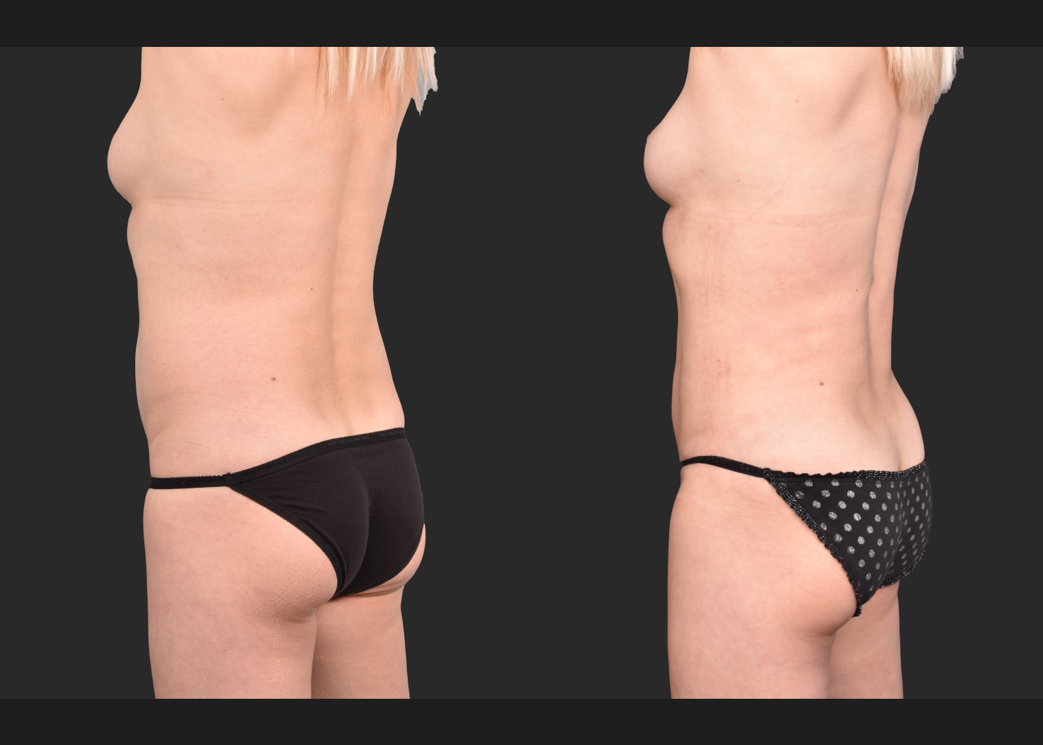 2153897 VASER lipo abdomen lower back 360 contouring renuvion before after- left oblique back