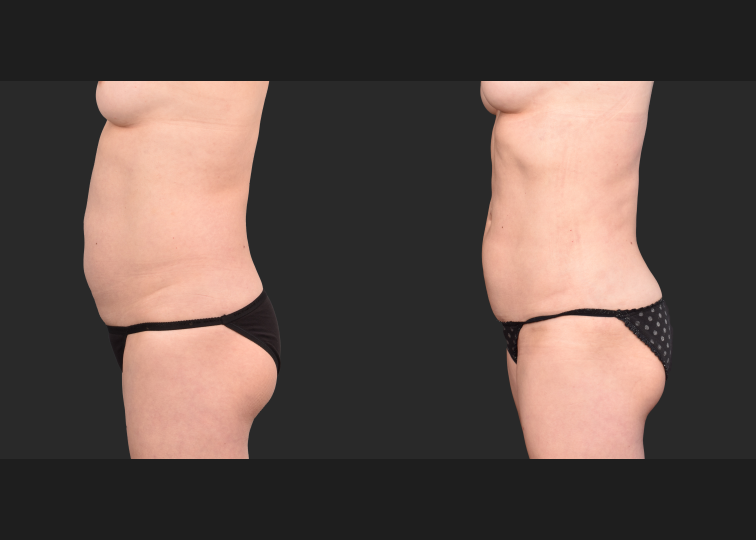 2153897 VASER lipo abdomen lower back 360 contouring renuvion before after- left