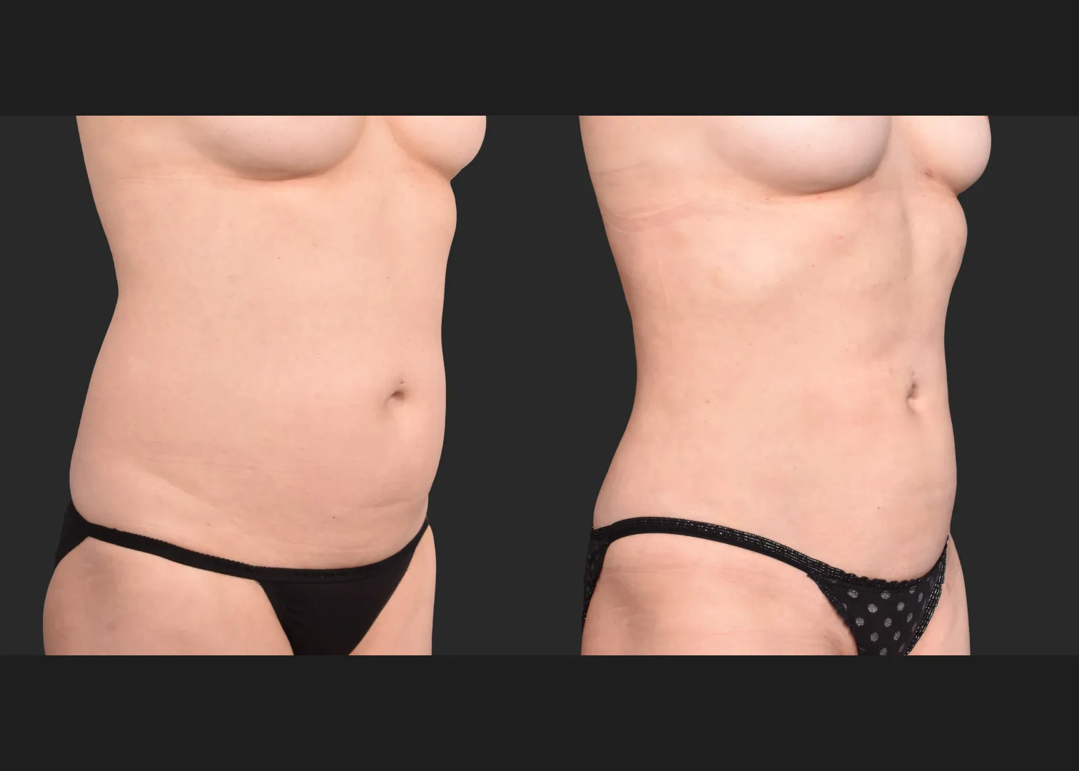 2153897 VASER lipo abdomen lower back 360 contouring renuvion before after- right oblique front