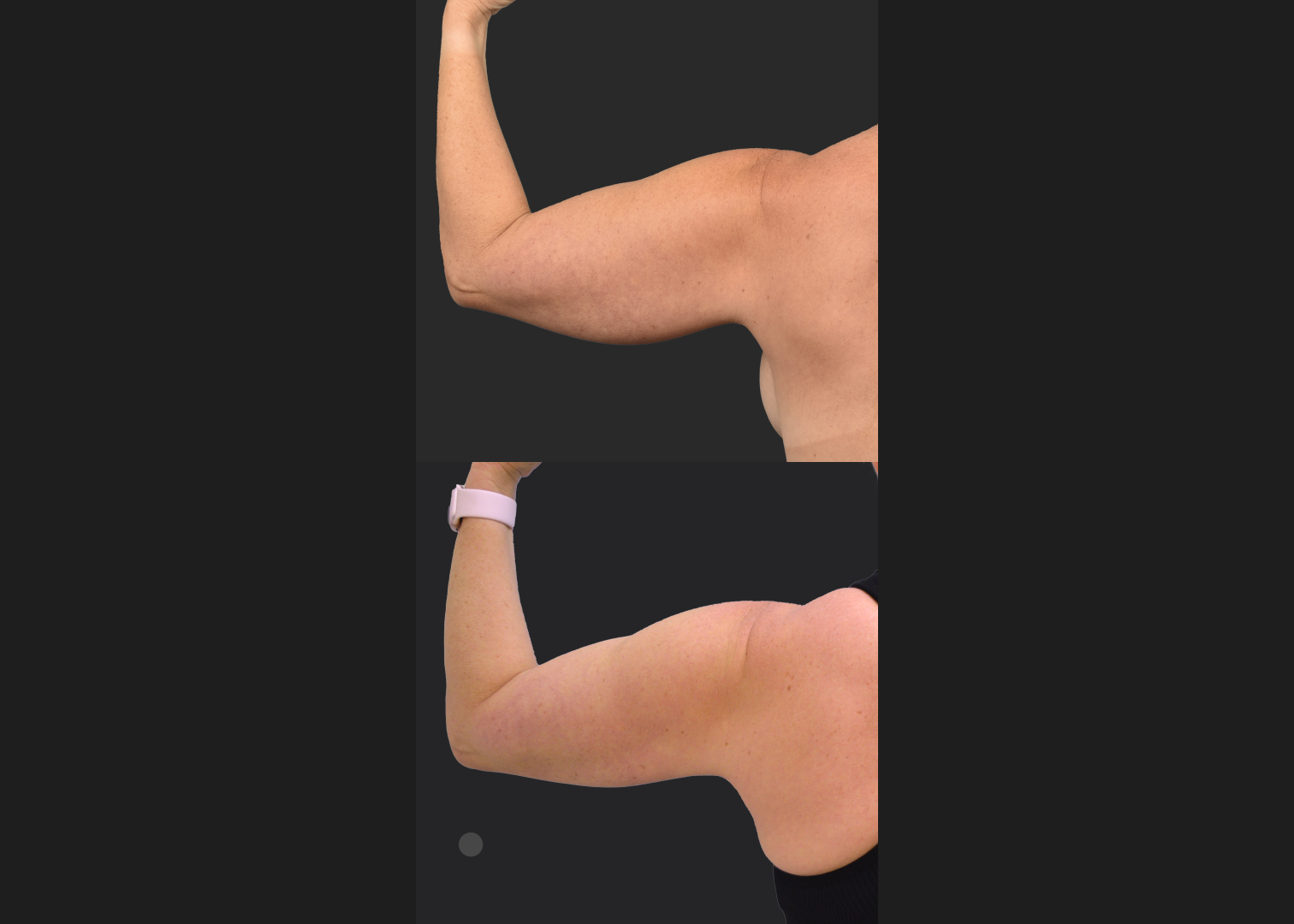 2155199 Arm lipo Renuvion Skin tightening scarless arm lift high def before after- back flexed left