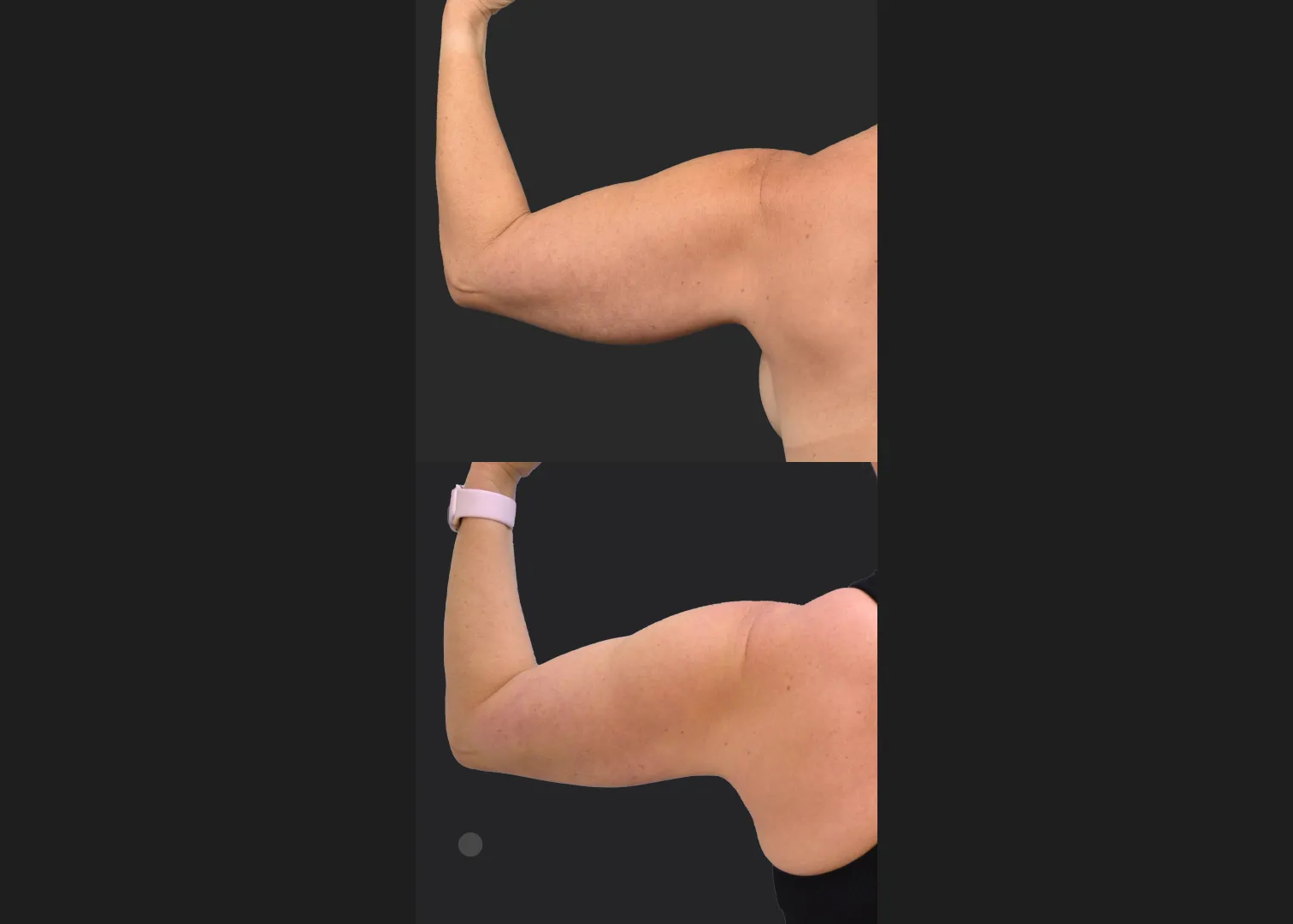 2155199 Arm lipo Renuvion Skin tightening scarless arm lift high def before after- back flexed left