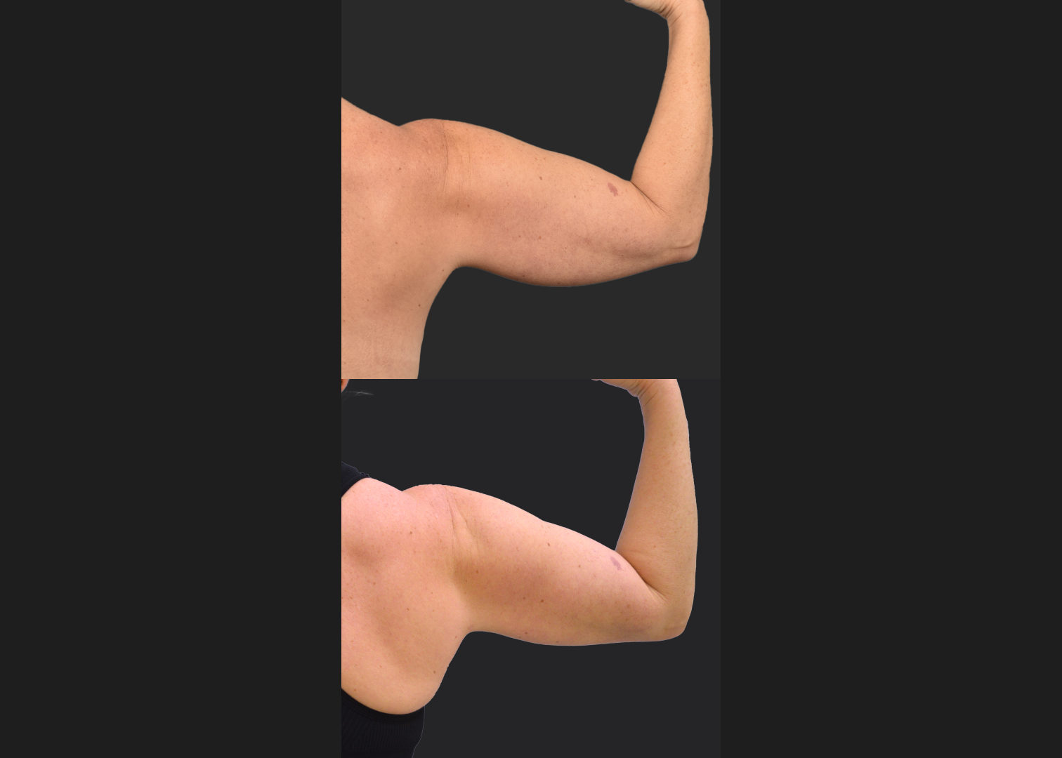 2155199 Arm lipo Renuvion Skin tightening scarless arm lift high def before after- back flexed right