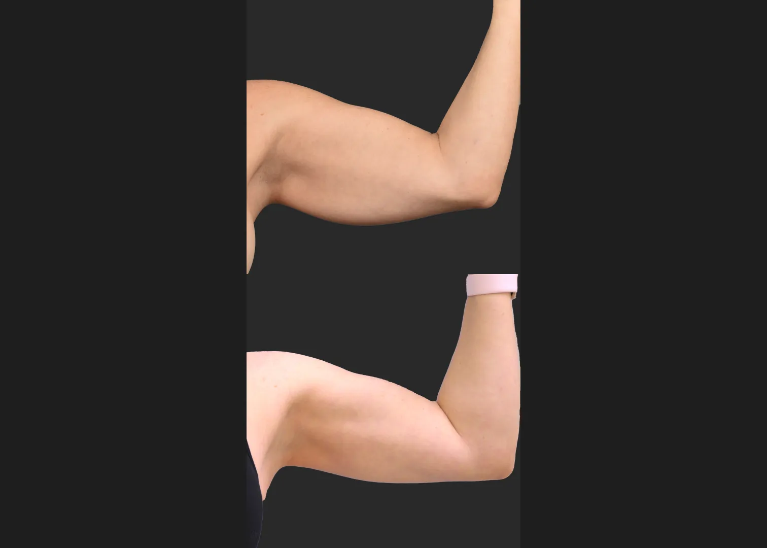 2155199 Arm lipo Renuvion Skin tightening scarless arm lift high def before after- front flexed left
