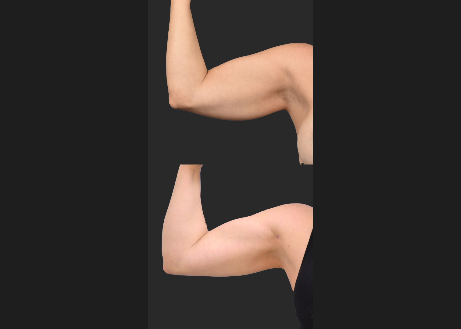 2155199 Arm lipo Renuvion Skin tightening scarless arm lift high def before after- front flexed right