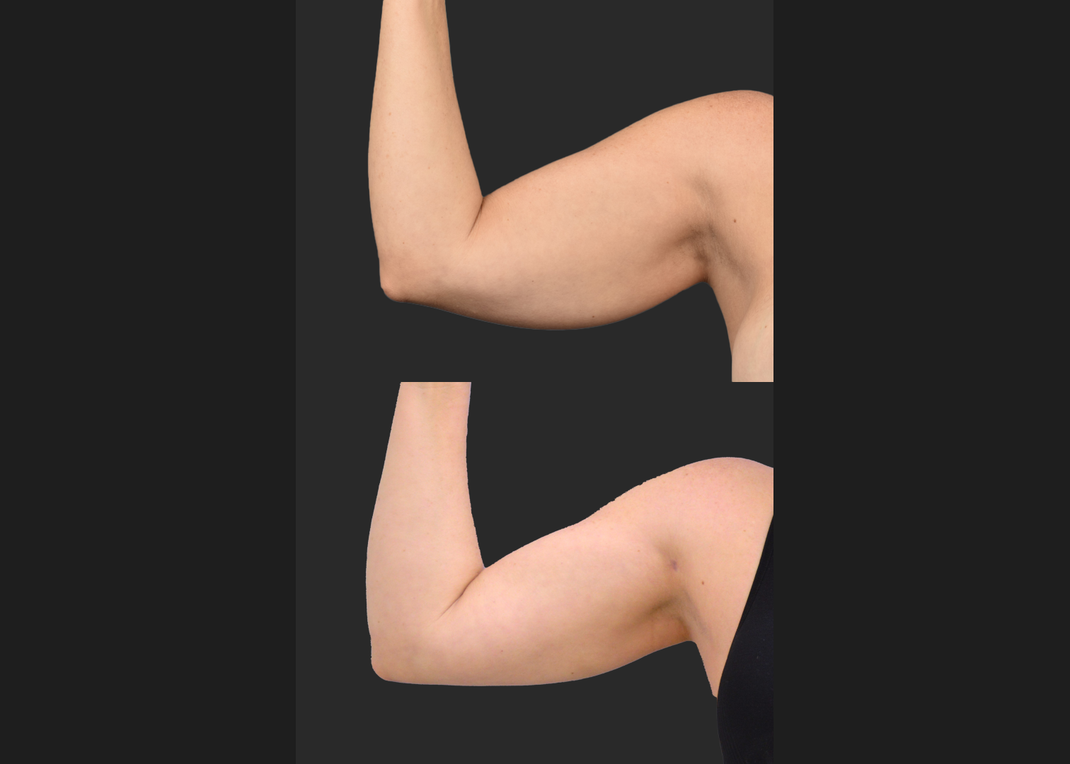 2155199 Arm lipo Renuvion Skin tightening scarless arm lift high def before after- front right
