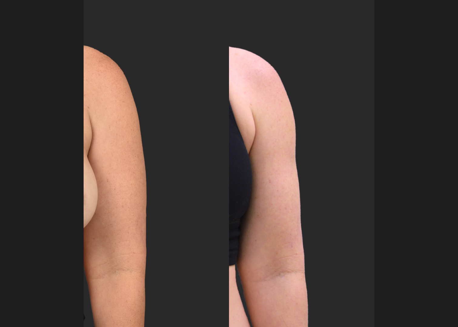 2155199 Arm lipo Renuvion Skin tightening scarless arm lift high def before after- left