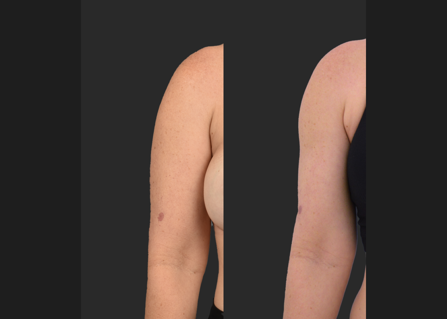 2155199 Arm lipo Renuvion Skin tightening scarless arm lift high def before after- right