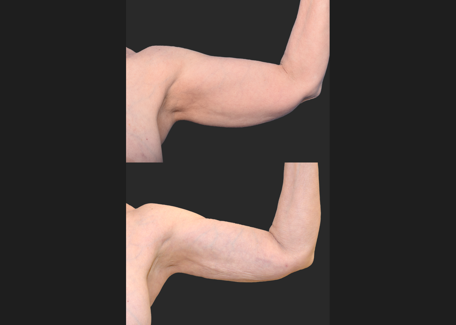 2155949 Arm Lipo Renuvion Before After- left ant
