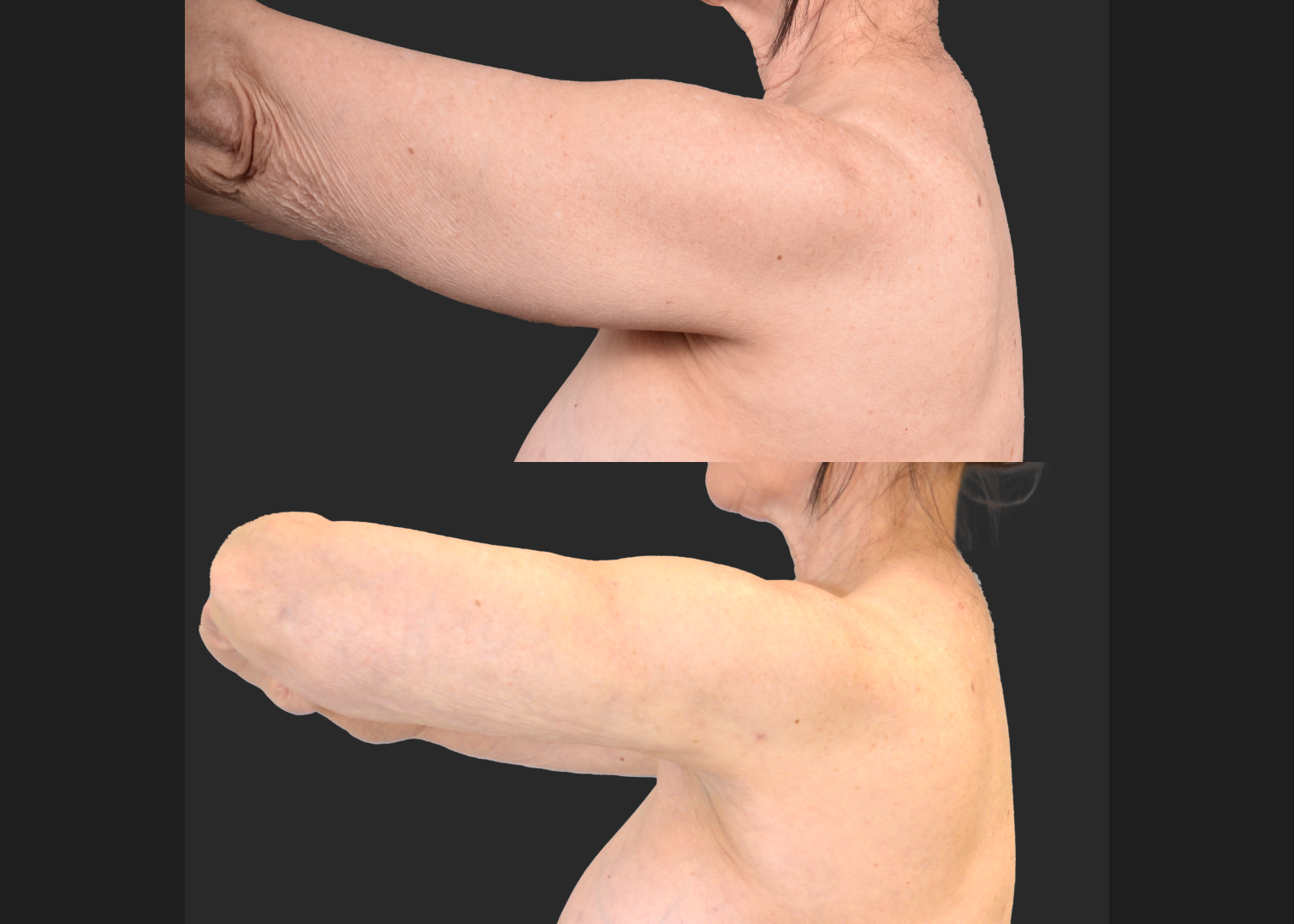2155949 Arm Lipo Renuvion Before After- left lateral