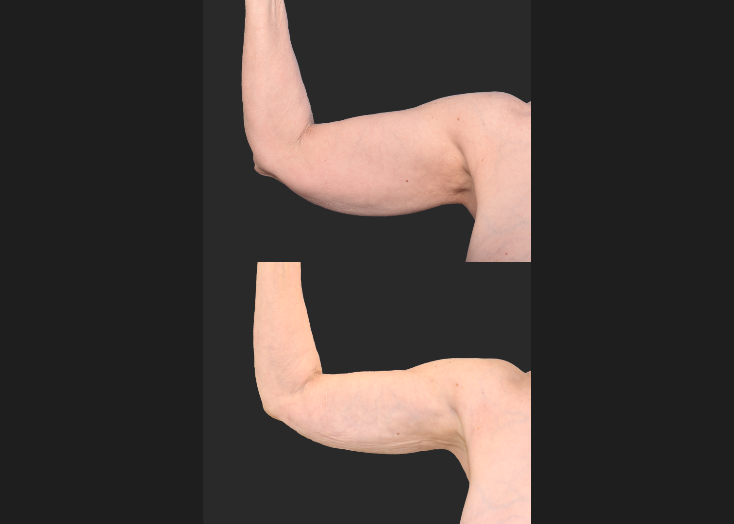 2155949 Arm Lipo Renuvion Before After- right ant