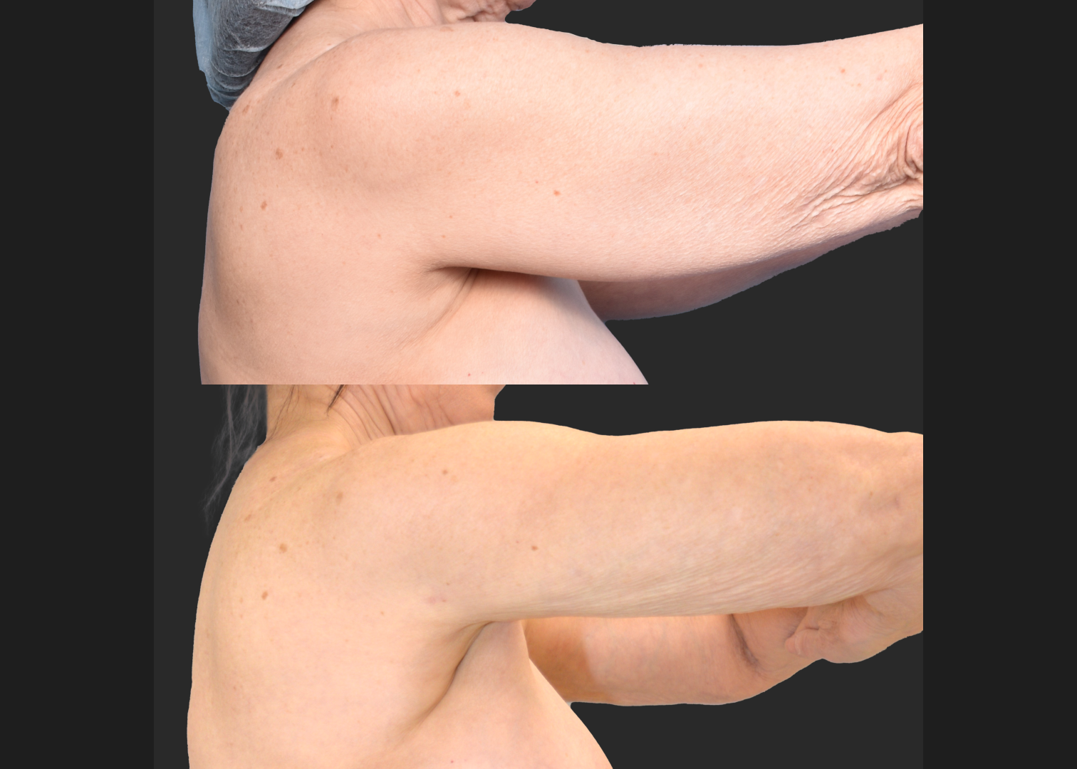2155949 Arm Lipo Renuvion Before After- right lateral