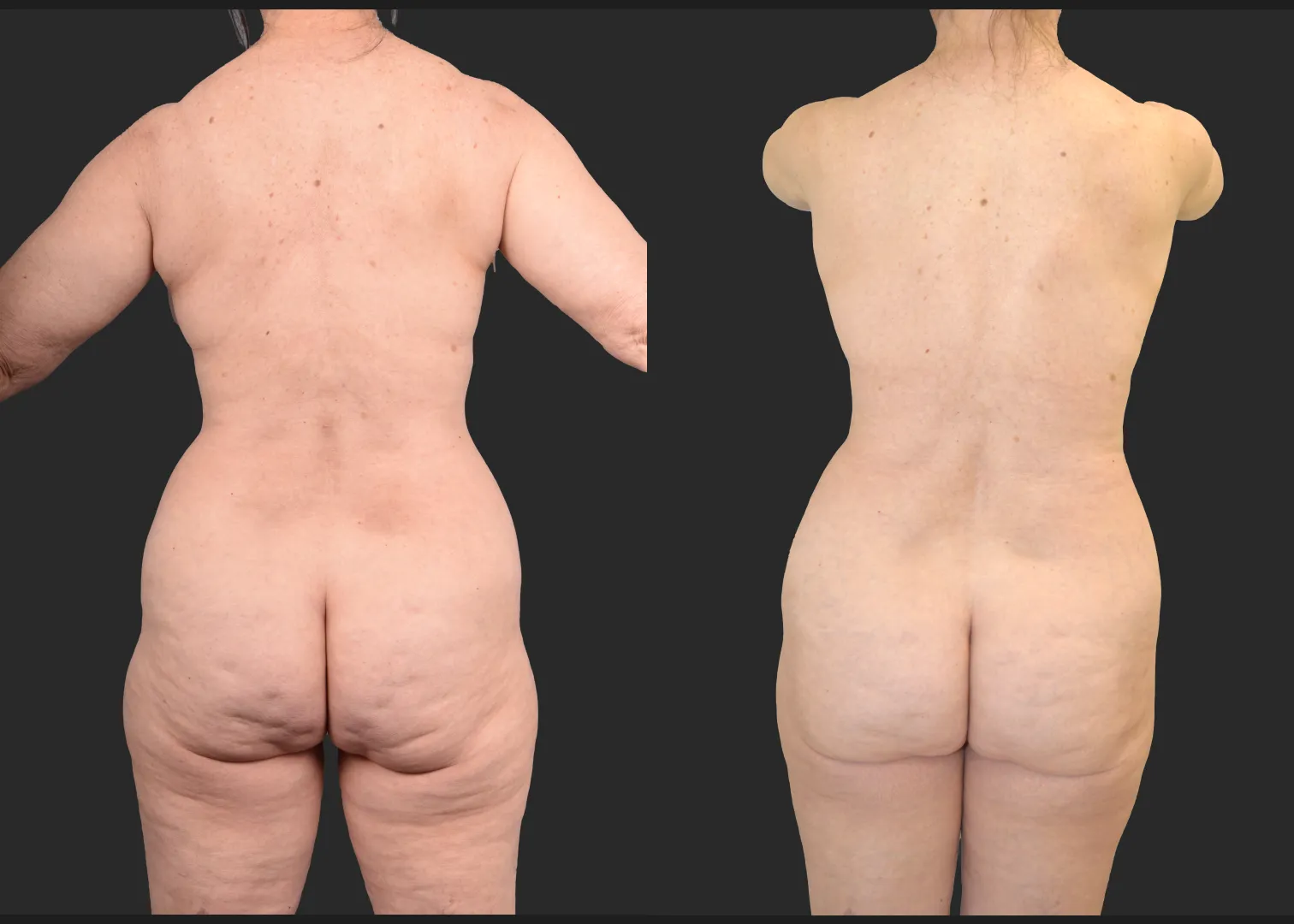 2155949 VASER lipo and renuvion abdomen arms lateral thighs renuvion petite bbl fat transfer to buttock c-section scar revision mini tummy tuck before after- back