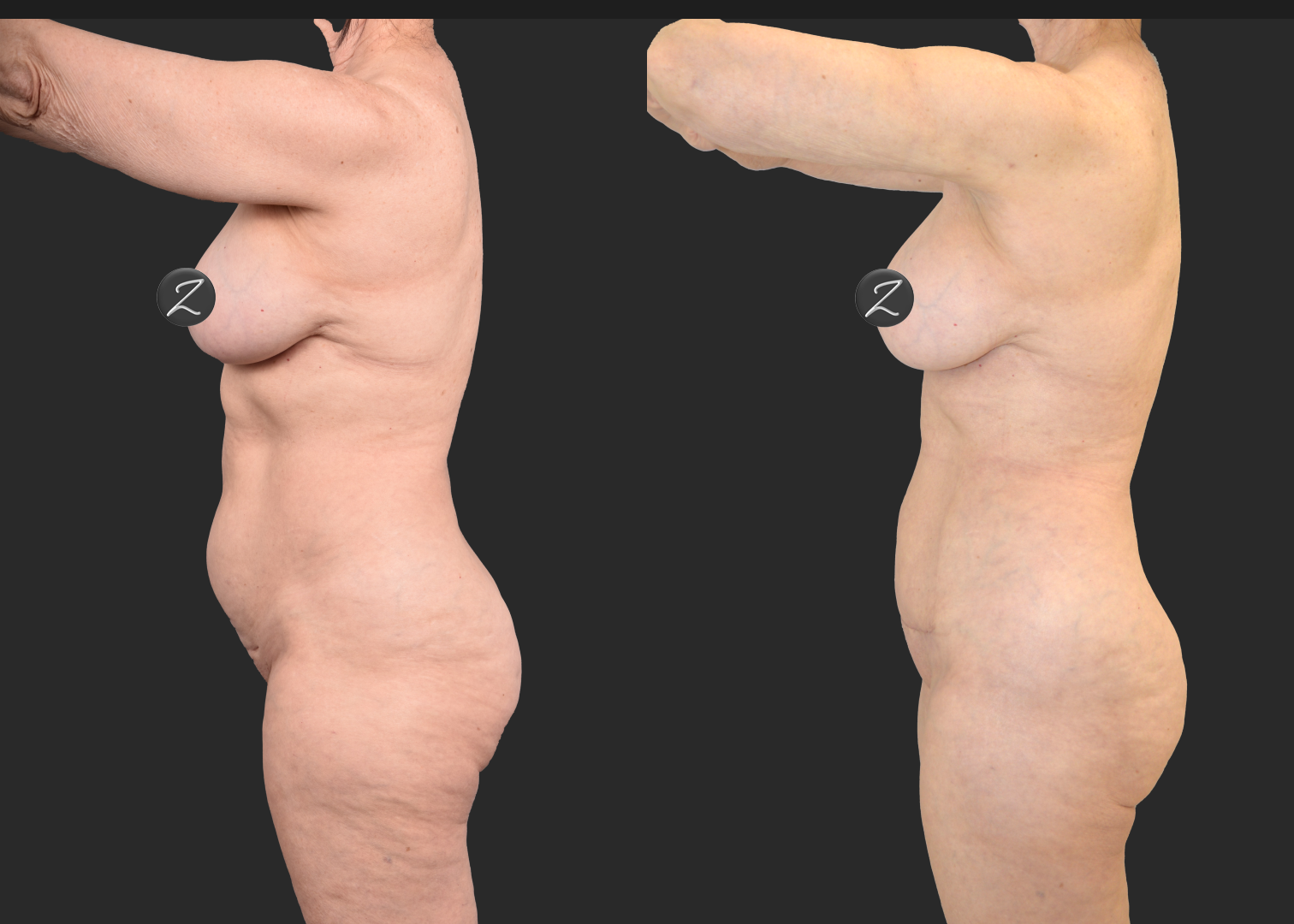 2155949 VASER lipo and renuvion abdomen arms lateral thighs renuvion petite bbl fat transfer to buttock c-section scar revision mini tummy tuck before after- left
