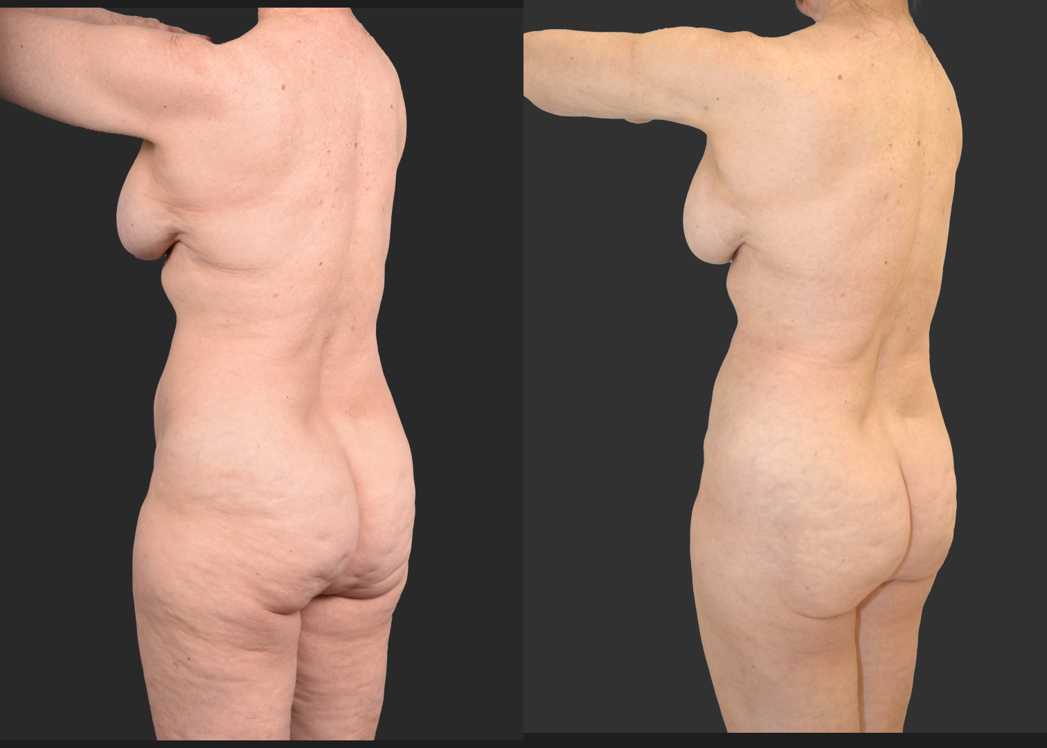 2155949 VASER lipo and renuvion abdomen arms lateral thighs renuvion petite bbl fat transfer to buttock c-section scar revision mini tummy tuck before after- post left oblique