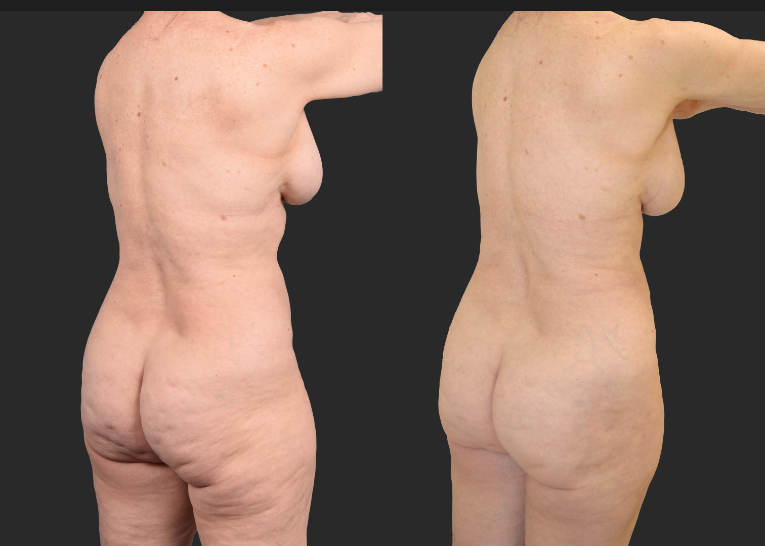 2155949 VASER lipo and renuvion abdomen arms lateral thighs renuvion petite bbl fat transfer to buttock c-section scar revision mini tummy tuck before after- post right oblique