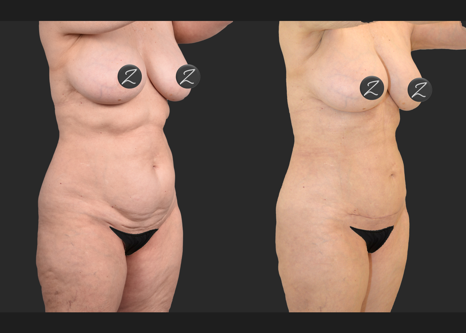 2155949 VASER lipo and renuvion abdomen arms lateral thighs renuvion petite bbl fat transfer to buttock c-section scar revision mini tummy tuck before after- right oblique