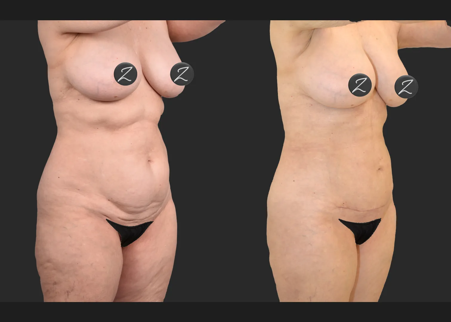 2155949 VASER lipo and renuvion abdomen arms lateral thighs renuvion petite bbl fat transfer to buttock c-section scar revision mini tummy tuck before after- right oblique