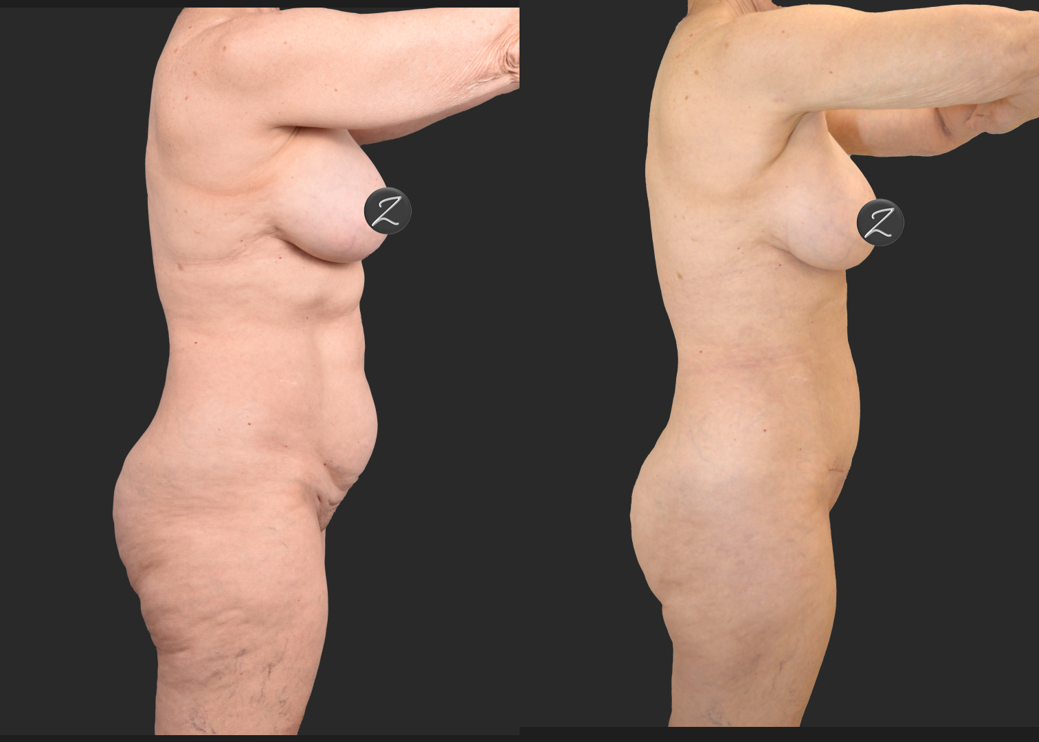 2155949 VASER lipo and renuvion abdomen arms lateral thighs renuvion petite bbl fat transfer to buttock c-section scar revision mini tummy tuck before after- right