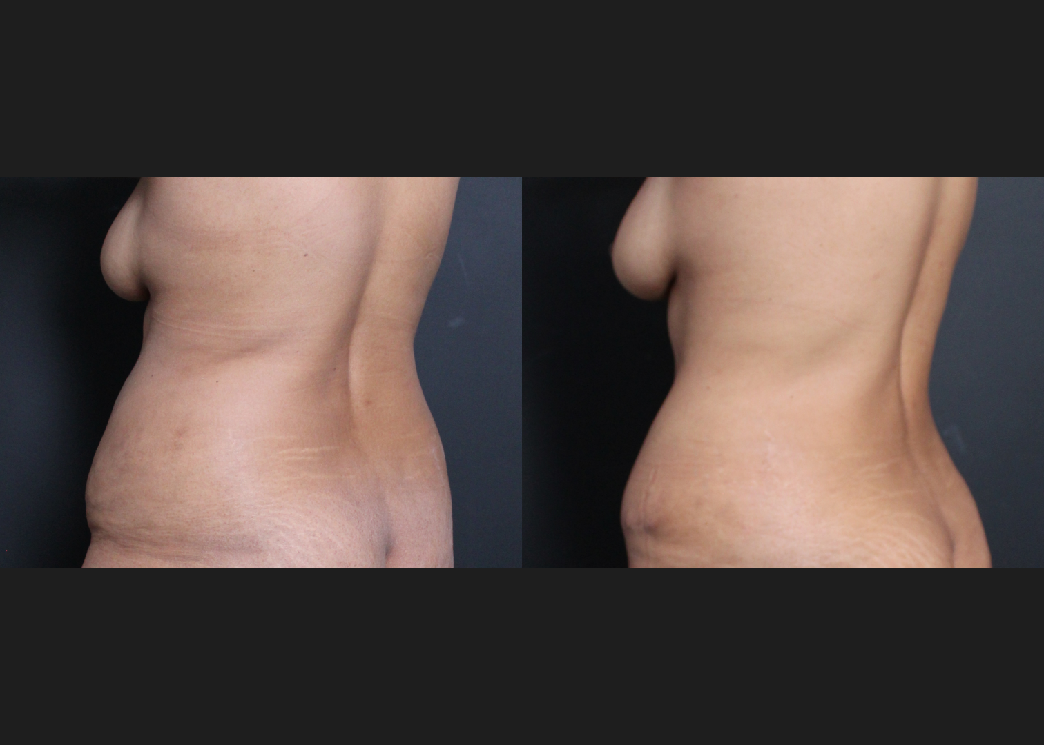 245922 Lipoabdominoplasty with rectus diastasis repair and lower back vaser liposuction before after- back left oblique