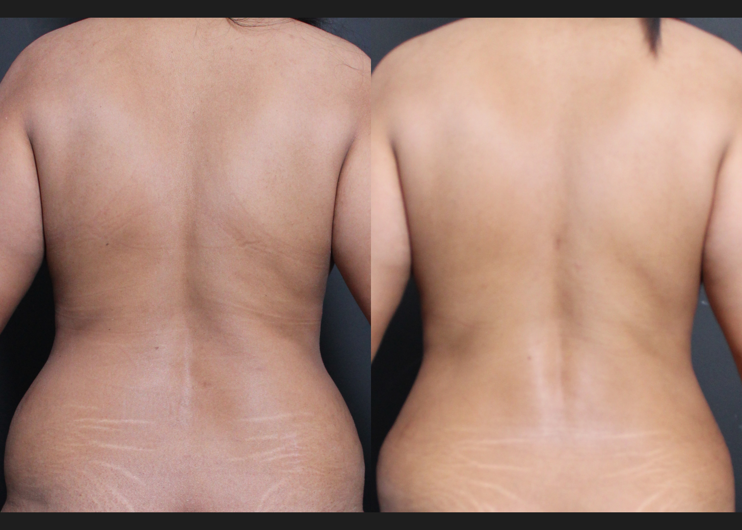 245922 Lipoabdominoplasty with rectus diastasis repair and lower back vaser liposuction before after- back