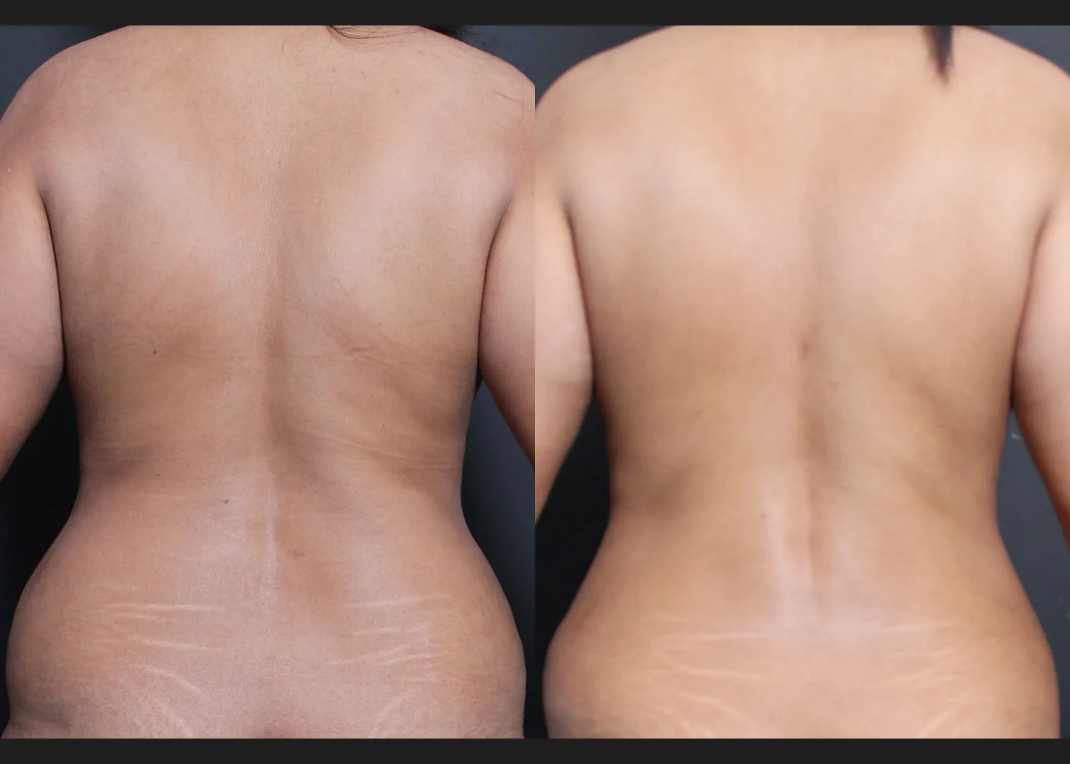 245922 Lipoabdominoplasty with rectus diastasis repair and lower back vaser liposuction before after- back