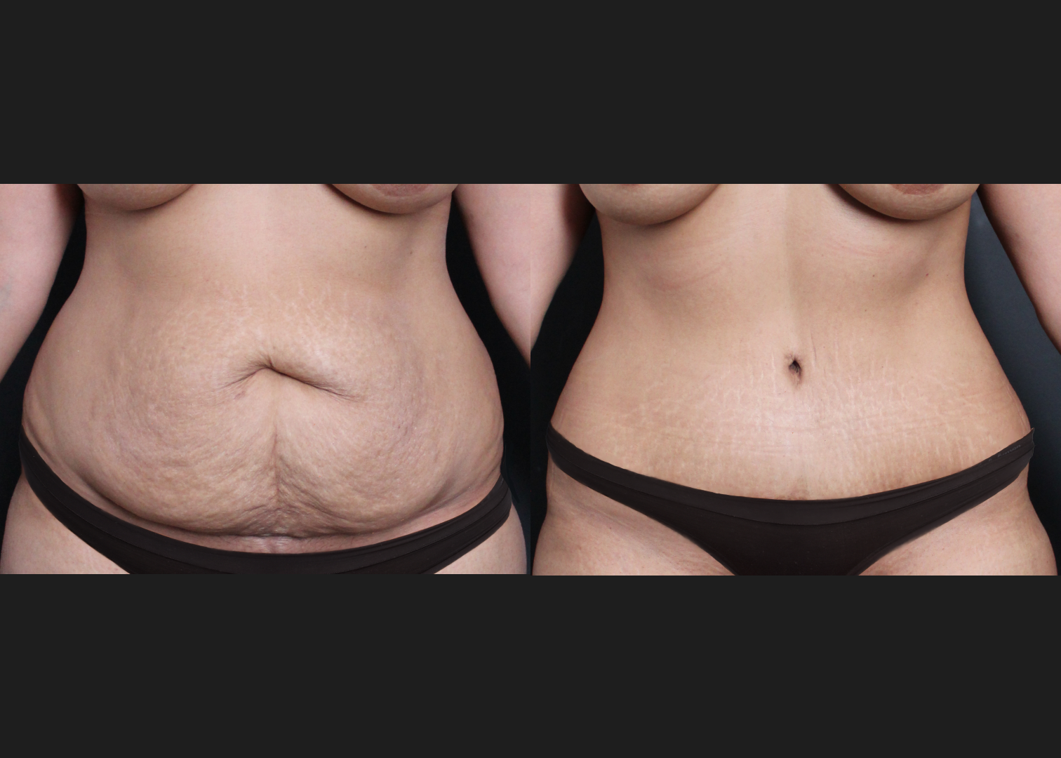 245922 Lipoabdominoplasty with rectus diastasis repair and lower back vaser liposuction before after- front