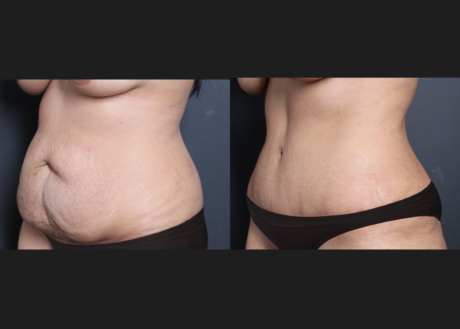 245922 Lipoabdominoplasty with rectus diastasis repair and lower back vaser liposuction before after- left oblique
