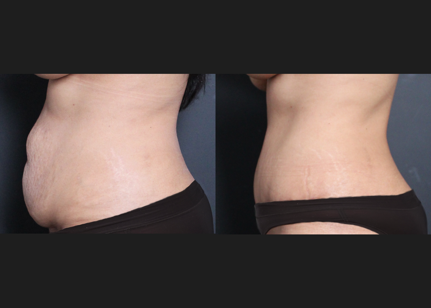 245922 Lipoabdominoplasty with rectus diastasis repair and lower back vaser liposuction before after- left