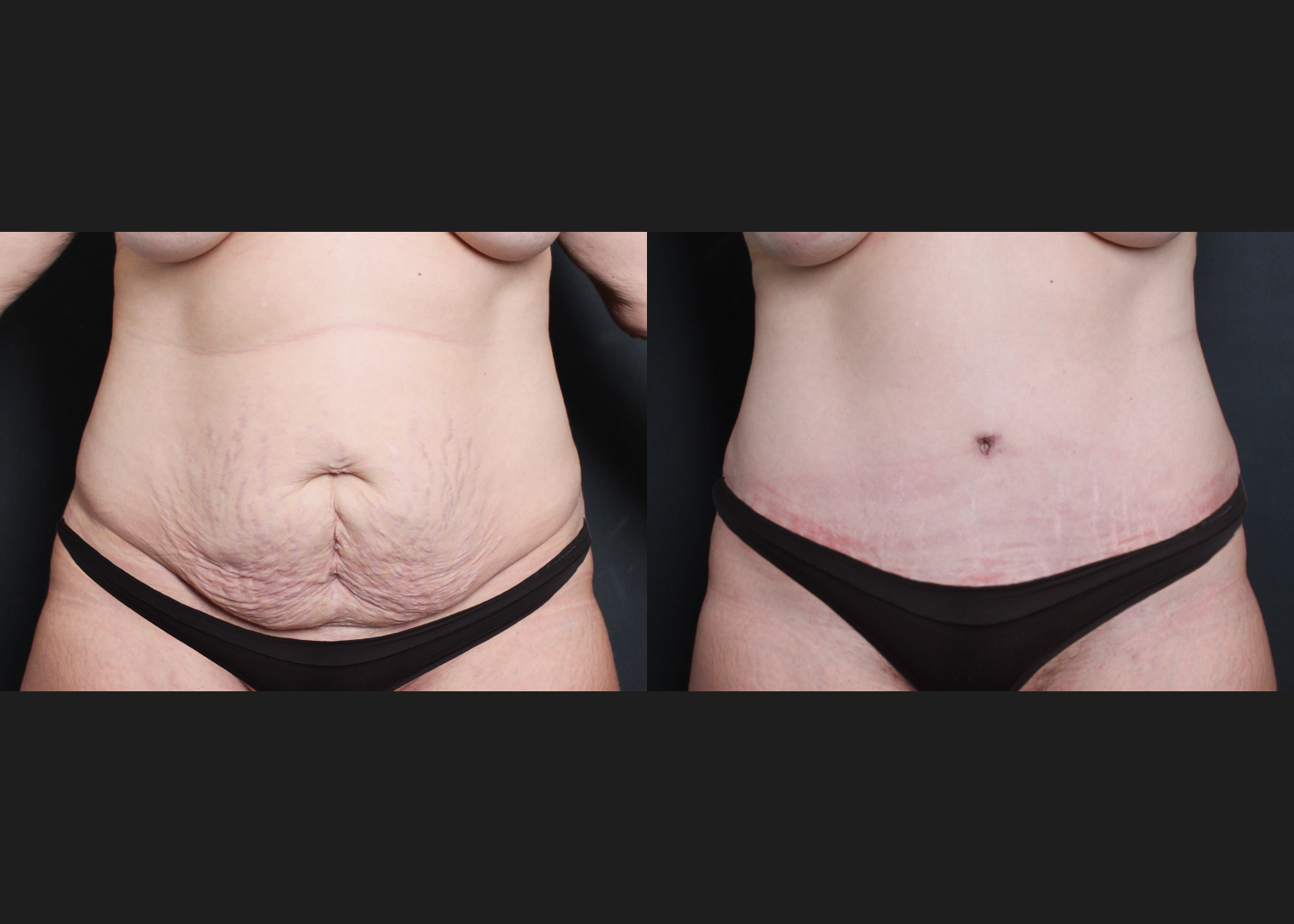 294076 Extended Lipoabdominoplasty before after smaller underwear- front