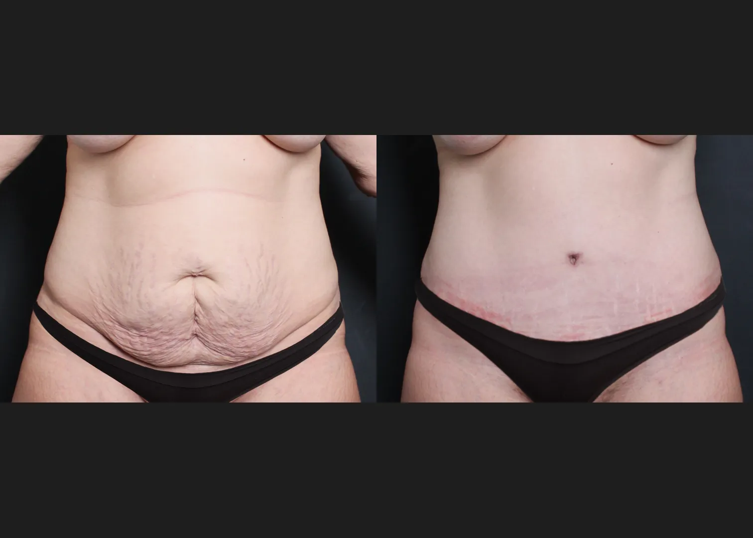 294076 Extended Lipoabdominoplasty before after smaller underwear- front