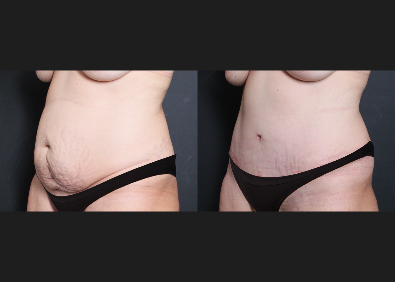 294076 Extended Lipoabdominoplasty before after smaller underwear- left oblique