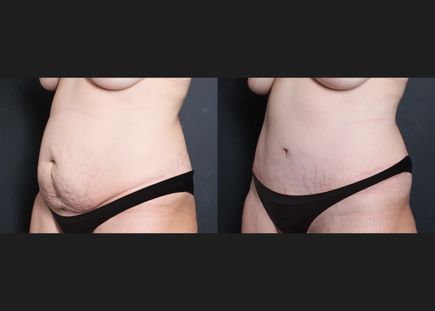 294076 Extended Lipoabdominoplasty before after smaller underwear- left oblique