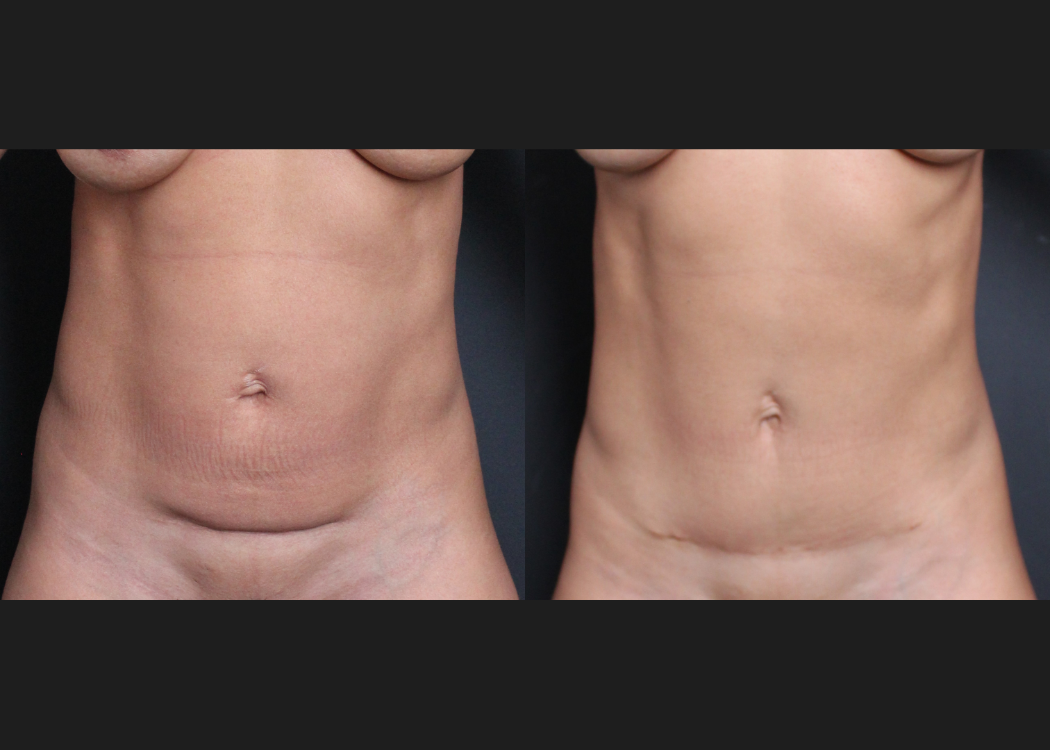 384617 C-section scar revision with mini tummy tuck and abdomen renuvion before after- front