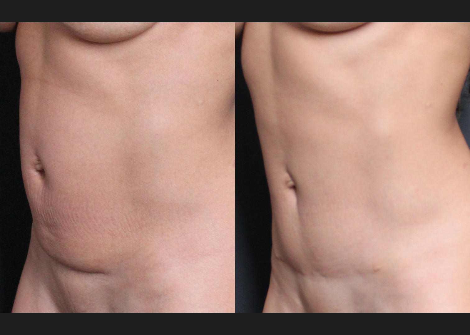 384617 C-section scar revision with mini tummy tuck and abdomen renuvion before after- left oblique