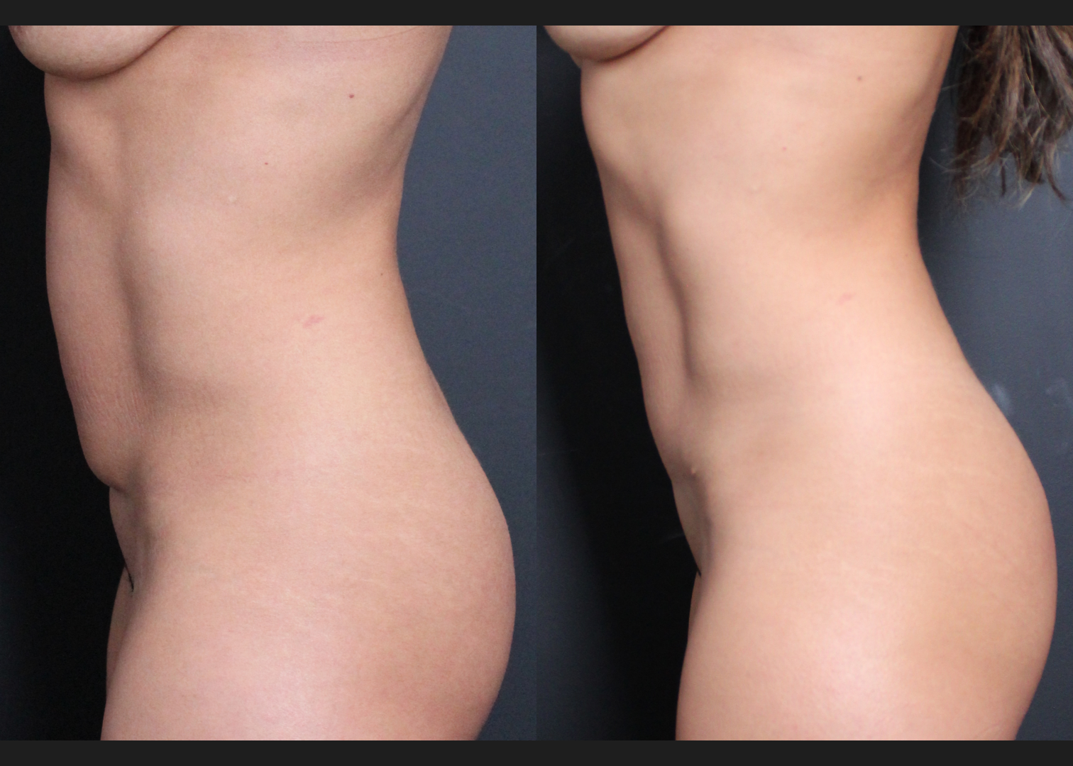 384617 C-section scar revision with mini tummy tuck and abdomen renuvion before after- left