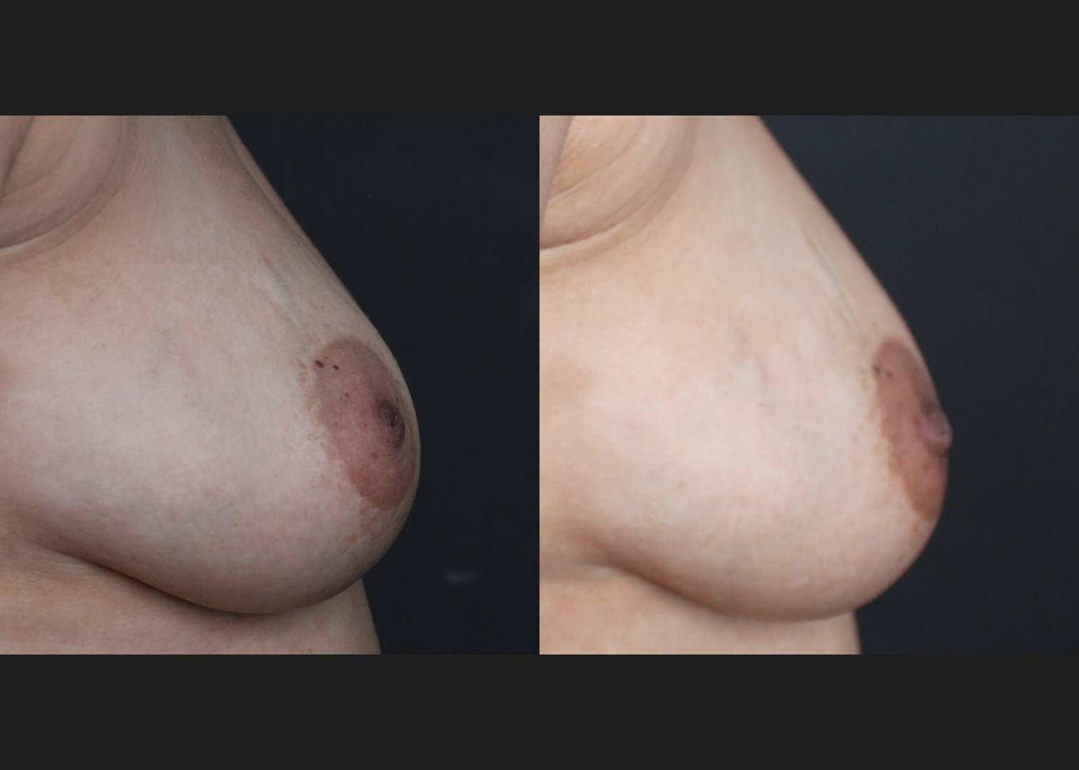 384768 Inverted nipple repair before after 16 months- lateral right