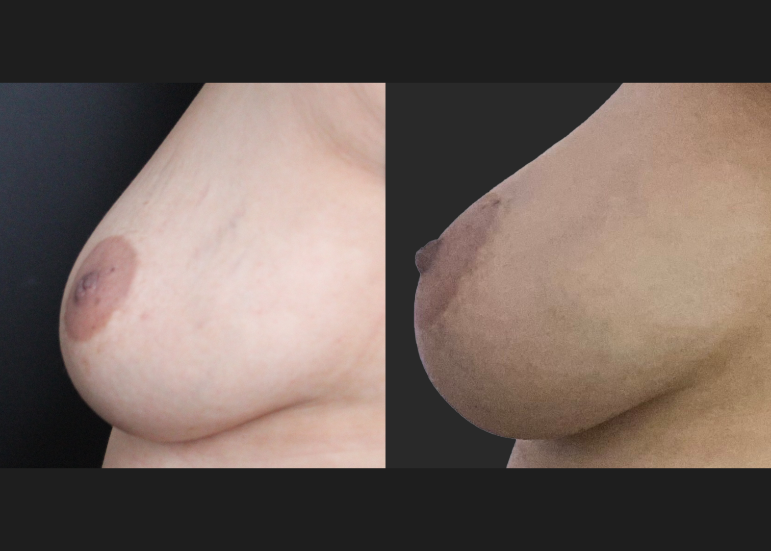 384768 Inverted nipple repair before after 16 months- lateral